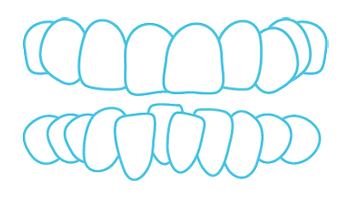 Ilustración de apiñamiento dental